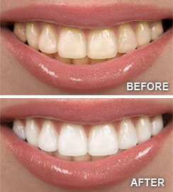 Before/After Teeth Whitening